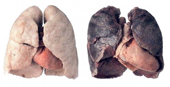 Comparaison poumons sains et poumons fumeur
